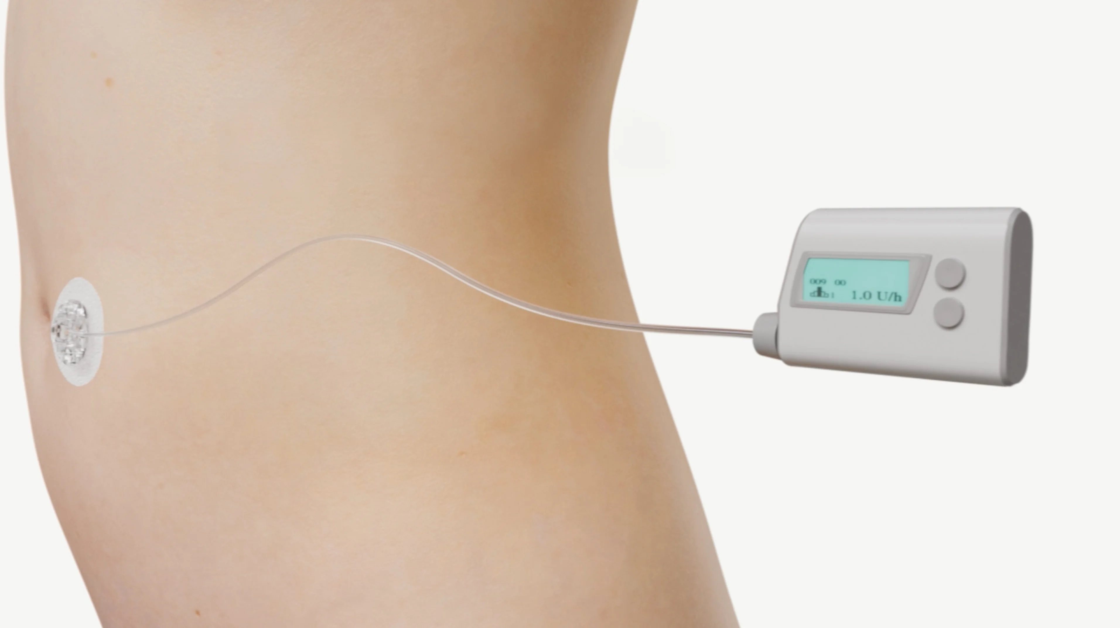 An illustration of an insulin pump and infusion set.